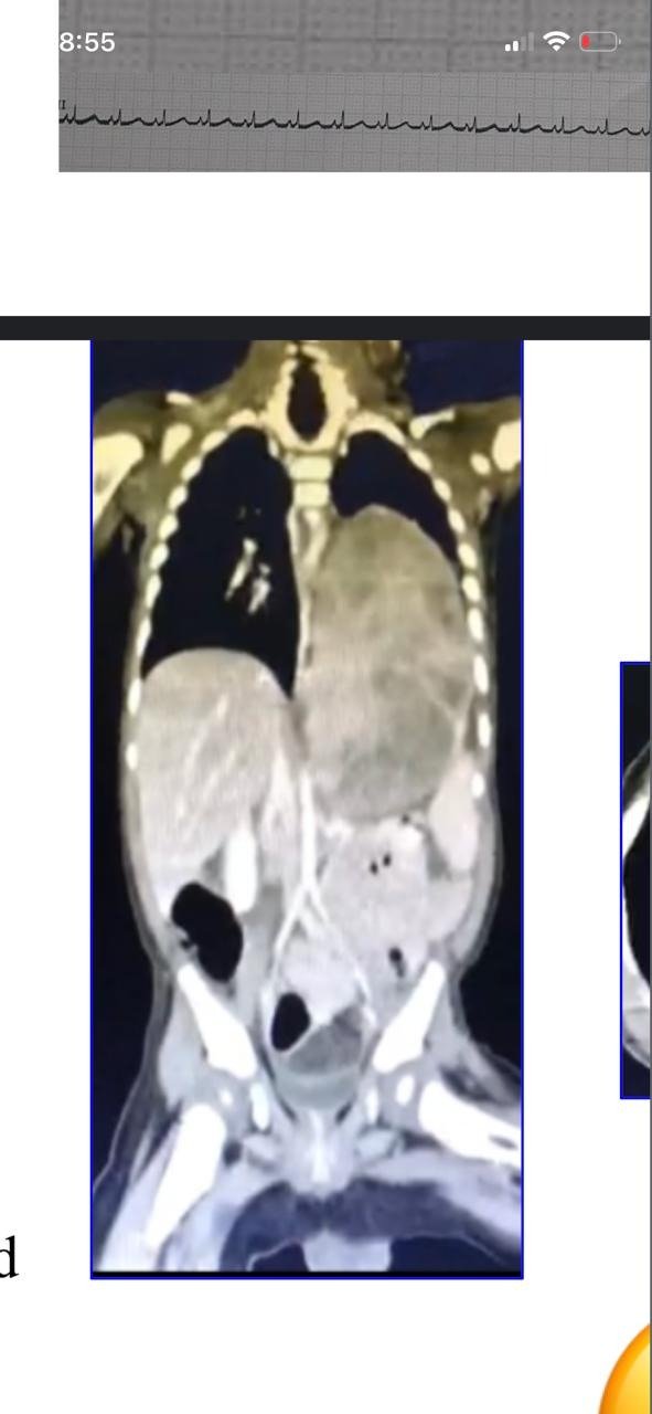 Complex Thoraco-Abdominal Neuroblastoma CT scan