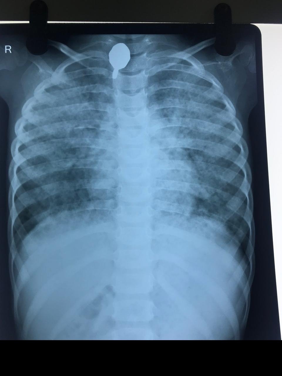 Chest X-ray showing recovery from Pulmonary Alveolar Proteinosis